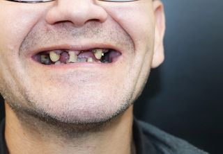 Imagem aproximada de boca de homem com dentes apodrecidos