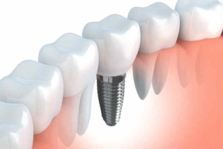 Além de substituir um ou mais dentes que estejam faltando, a prótese dentária fixa ainda contribui para um belo sorriso