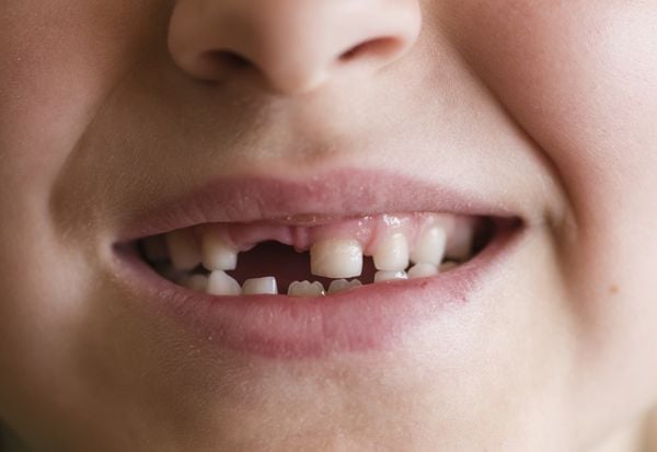 Criança sorrindo sem um dos dentes