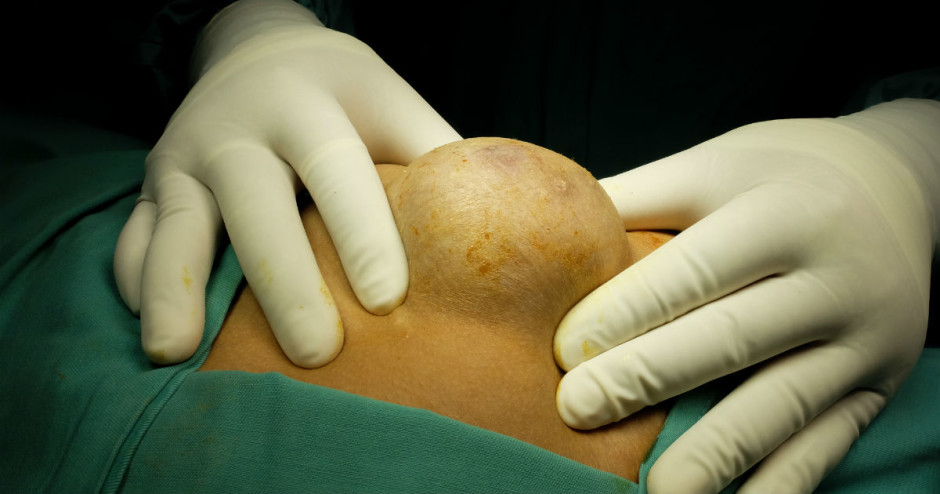 Dermatologista retira lipoma enorme de paciente