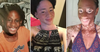 Jamila Davis diz ter revertido vitiligo ao aderir à dieta vegana