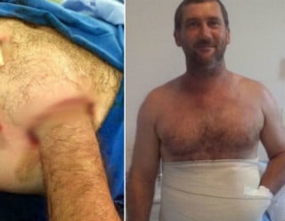 Homem teve mão colocada dentro da barriga para evitar amputação