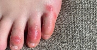 COVID-19: dedos dos pés inchados podem ser sinal da doença