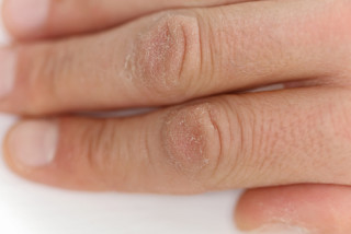 7 fatores que agravam a pele seca