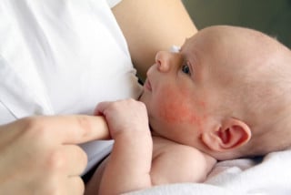 Pele do bebê: problemas que podem aparecer nos primeiros meses