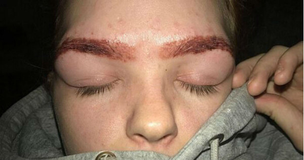 Garota tem rosto queimado após tingir sobrancelha em casa