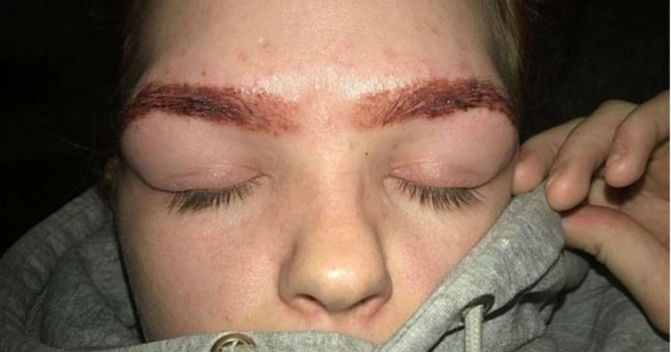 Garota tem rosto queimado após tingir sobrancelha em casa