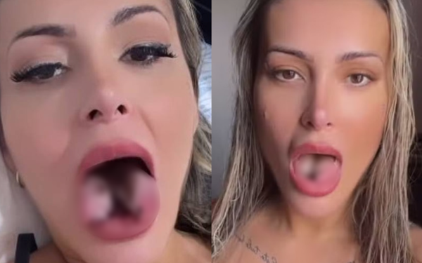 Andressa Urach após a cirurgia de bifurcação da língua