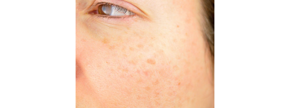 Alergia no rosto: entenda as principais causas