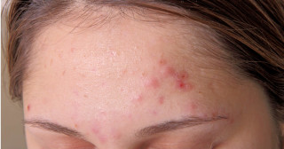 Especialista responde 12 perguntas sobre acne