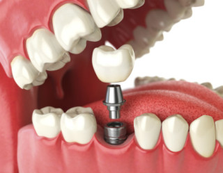 Pessoas com diabetes podem fazer implante dentário?