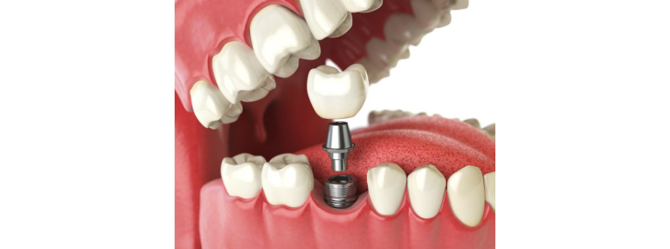Pessoas com diabetes podem fazer implante dentário?