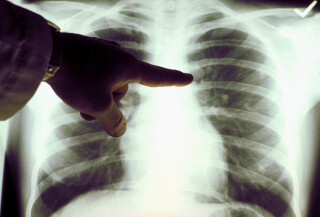 Imagem de raio X de pulmão