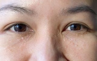 O milium&nbsp;aparece na camada mais superficial da pele, geralmente no rosto, com um a três milímetros de diâmetro.