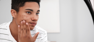 Excesso de acne pode atrapalhar a autoestima e provocar depressão