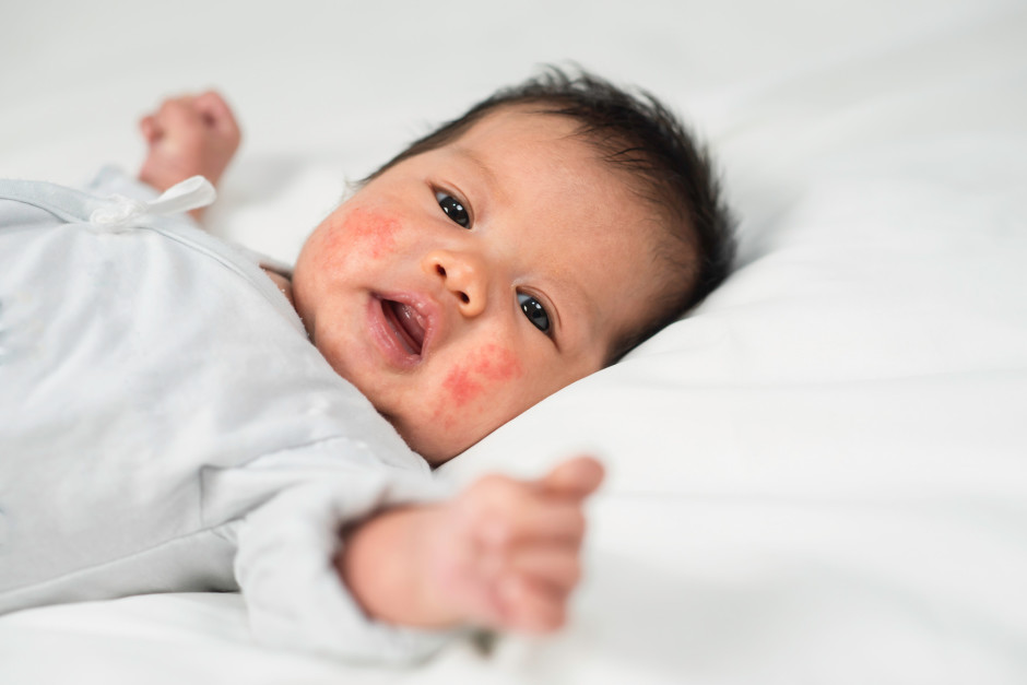 Bebê com dermatite atópica deitado e olhando para a câmera