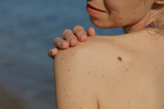 Mulher de costas com uma verruga perto do ombro - Foto: Getty Images