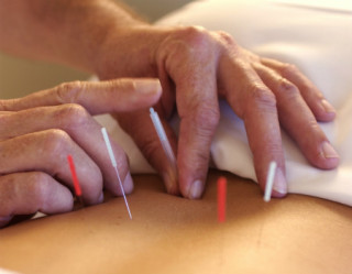 Mulher fazendo acupuntura