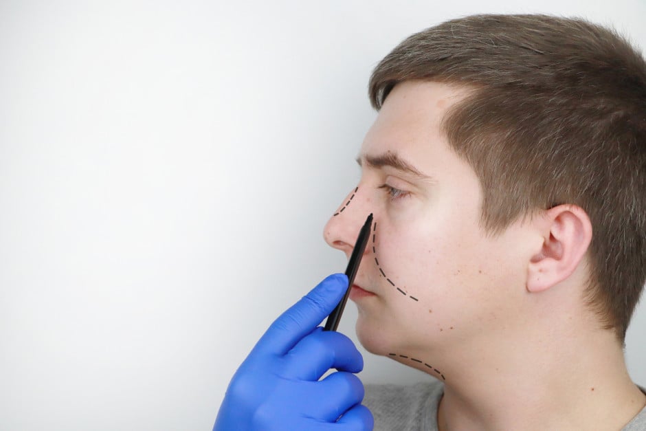 Homem com marcações no rosto antes de rinoplastia