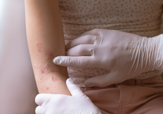 Recorte de imagem de médico examinando o braço de uma criança com dermatite atópica