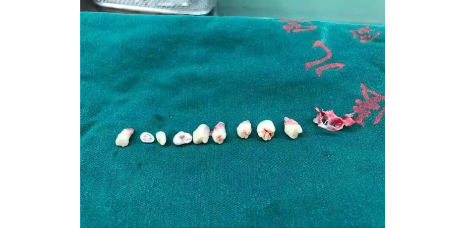 Médicos removem nove dentes do cérebro de menino de 5 anos