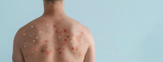 Foto de costas masculinas com erupções cutâneas causadas pela varíola dos macacos