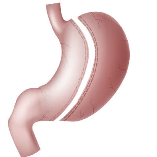 Ilustração de uma gastrectomia vertical - Foto: Getty Images