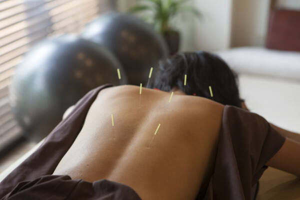 Mulher fazendo acupuntura deitada em maca de barriga para baixo