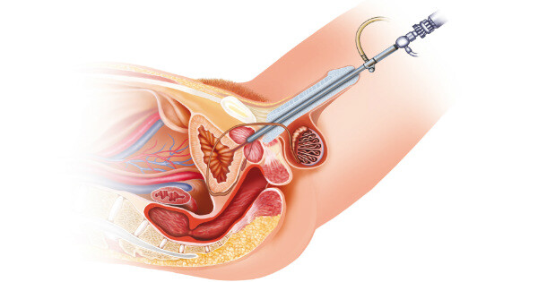 Biópsia próstata 