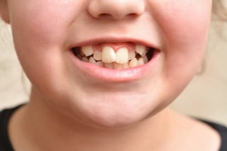 Criança com dentes tortos sorrindo
