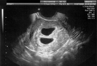 Imagem de ultrassonografia de gravidez gemelar com quatro semanas.
