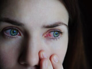 Close Up dos olhos de uma mulher com conjuntivite