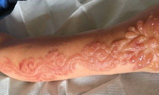 Tatuagem de henna causa queimadura química em menina de sete anos