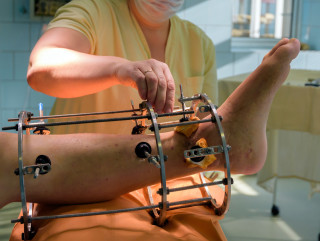 médica realizando procedimento ortopédico, ajustando fixador externo em perna de paciente após cirurgia ortopédica.