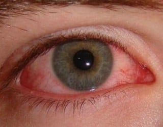 Olhos vermelhos são um dos principais sintomas do zika vírus