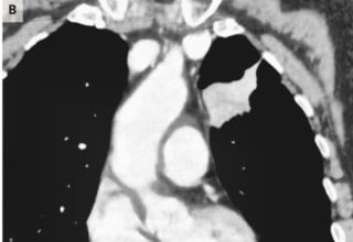 Exame de imagem da paciente, indicando o câncer de pulmão - Foto: Reprodução/The New England Journal of Medicine