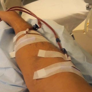 Marco mostra braço com fístula aplicada durante a hemodiálise - Foto: Acervo pessoal