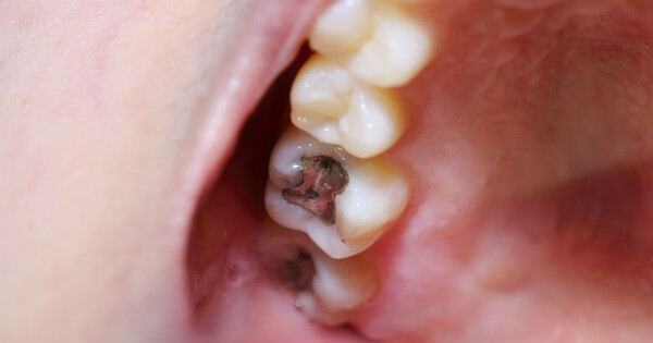 Dentes podres: veja os tratamentos possíveis