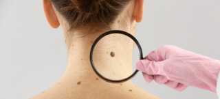Médico dermatologista examina pinta no pescoço de uma paciente com o auxílio de uma lupa