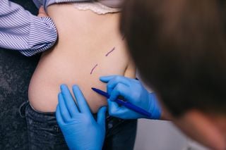 Paciente sendo marcada com caneta por médico