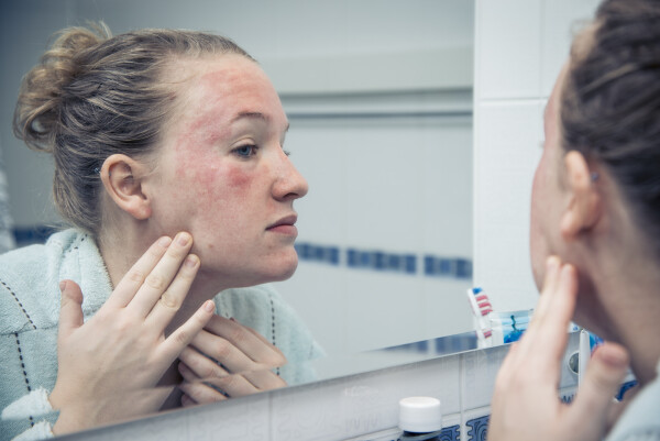 Mulher com marcas na pele de doença autoimune