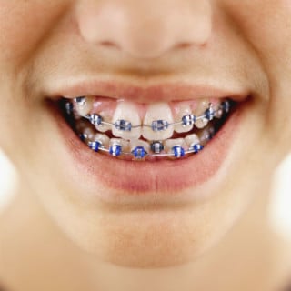 Adolescente com aparelho nos dentes - Foto: Getty Images