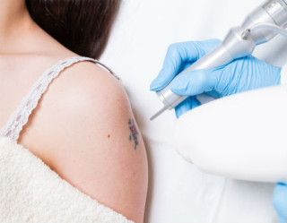Remoção de tatuagem provoca diversas dúvidas, entenda o tratamento