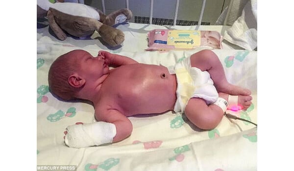 Bebê de 9 dias contrai meningite após ser beijado por adulto 
