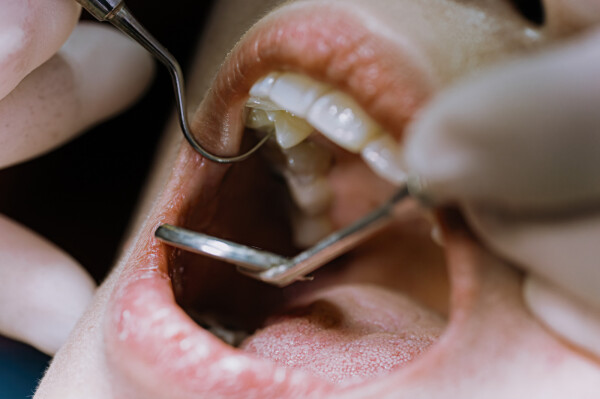 boca asiática chinesa mulher aberta para dentista examinando sua rotina dentária check-up