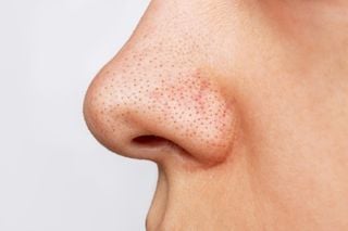 Pontinhos pretos no nariz podem ser reduzidos