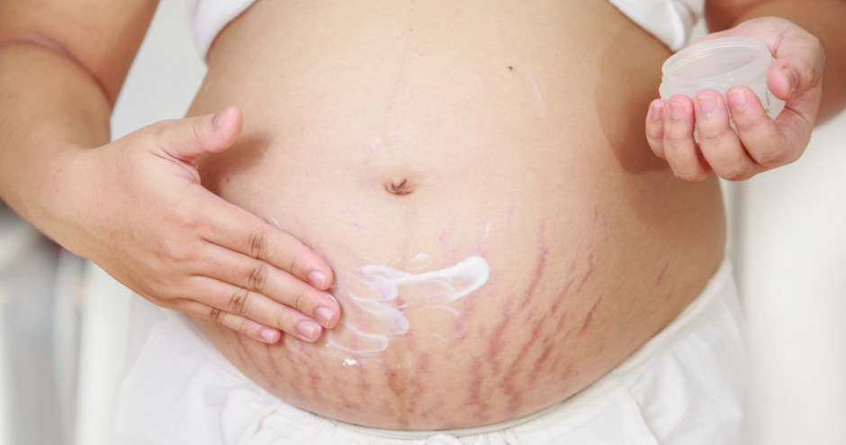 Estrias na gravidez: como evitá-las e tratá-las após o parto