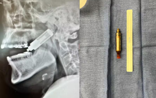 à esquerda, o raio x da face de um homem com um cigarro eletronico preso em seu crânio. à direita, um cigarro eletronico e uma pequena trena métrica medindo-o