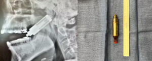 à esquerda, o raio x da face de um homem com um cigarro eletronico preso em seu crânio. à direita, um cigarro eletronico e uma pequena trena métrica medindo-o