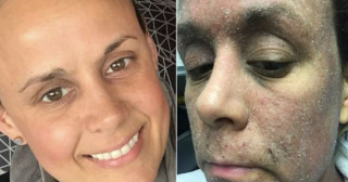 Mulher sofre com descamação da pele após parar de usar creme com esteróides